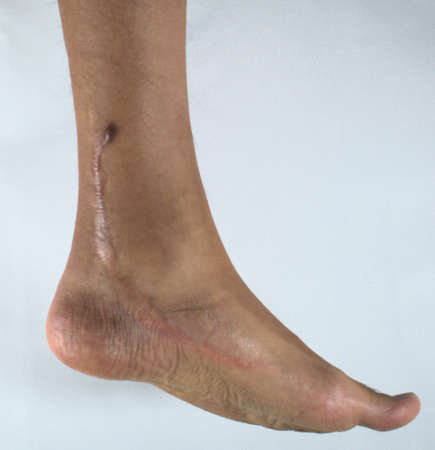 surgery scar to correct left clubfoot in an adultの写真素材