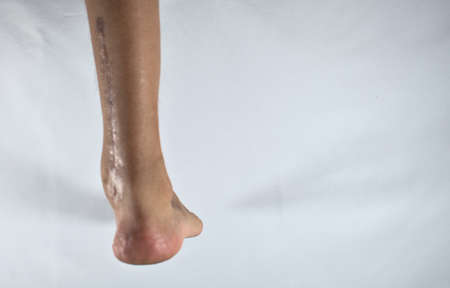 posterior view of the scar from clubfoot surgery in an adultの写真素材
