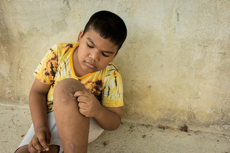 Little boy scratching the blisters scab on legの写真素材