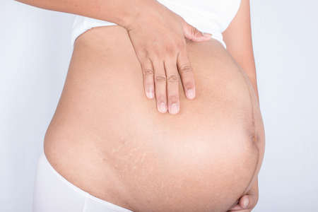 stretch marks on pregnant womenの写真素材