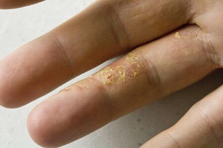 Closeup of Eczema Dermatitis on man hand and fingers. Skin peeling,desquamation of hand, gray modern background. Hand dermatitis, eczema. Finger problem, allergy. Copy space for your text.の写真素材