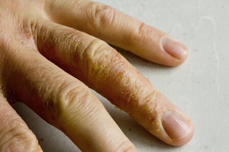 Closeup of Eczema Dermatitis on man hand and fingers. Skin peeling,desquamation of hand, gray modern background. Hand dermatitis, eczema. Finger problem, allergy. Copy space for your text.の写真素材