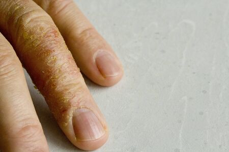 Closeup of Eczema Dermatitis on man hand and fingers. Skin peeling,desquamation of hand, gray modern background. Hand dermatitis, eczema. Finger problem, allergy. Copy space for your text.の写真素材