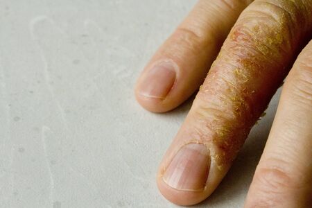 Closeup of Eczema Dermatitis on man hand and fingers. Skin peeling,desquamation of hand, gray modern background. Hand dermatitis, eczema. Finger problem, allergy. Copy space for your text.の写真素材