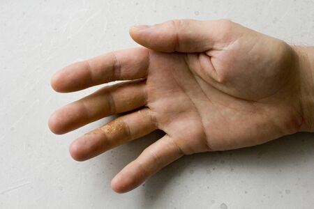 Closeup of Eczema Dermatitis on man hand and fingers. Skin peeling,desquamation of hand, gray modern background. Hand dermatitis, eczema. Finger problem, allergy. Copy space for your text.の写真素材