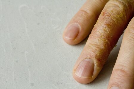 Closeup of Eczema Dermatitis on man hand and fingers. Skin peeling,desquamation of hand, gray modern background. Hand dermatitis, eczema. Finger problem, allergy. Copy space for your text.の写真素材