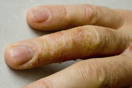 Closeup of Eczema Dermatitis on man hand and fingers. Skin peeling,desquamation of hand, gray modern background. Hand dermatitis, eczema. Finger problem, allergy. Copy space for your text.の写真素材