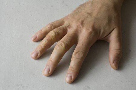 Closeup of Eczema Dermatitis on man hand and fingers. Skin peeling,desquamation of hand, gray modern background. Hand dermatitis, eczema. Finger problem, allergy. Copy space for your text.の写真素材