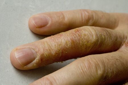 Closeup of Eczema Dermatitis on man hand and fingers. Skin peeling,desquamation of hand, gray modern background. Hand dermatitis, eczema. Finger problem, allergy. Copy space for your text.の写真素材