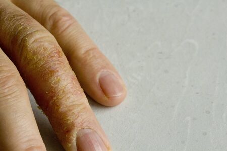 Closeup of Eczema Dermatitis on man hand and fingers. Skin peeling,desquamation of hand, gray modern background. Hand dermatitis, eczema. Finger problem, allergy. Copy space for your text.の写真素材