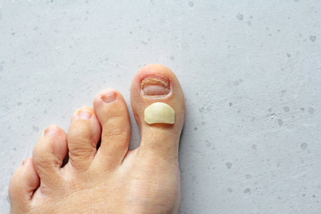 Exfoliation of nail on big toe, close-up in woman, girl. Toenail damage, fungus, trauma, big toe nail problems, nail detachment, on light white modern concrete background. Nail disease treatment.の写真素材