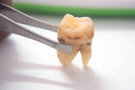 Tooth decay due to toothache and limestoneの写真素材