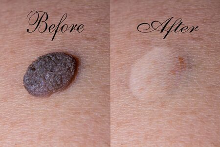 Mole removal inbornの写真素材