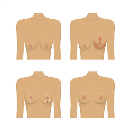 Lifting breast plastic surgeryのイラスト素材