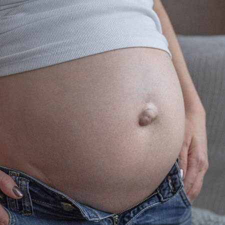 Umbilical hernia in a pregnant woman. Closeup. The concept of health and life