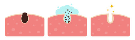 Cleaning clogged pores vector illustration. Skin care concept.のイラスト素材