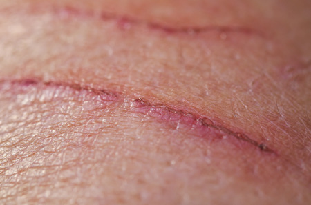 strong sick scratch wound infection on human skinの写真素材