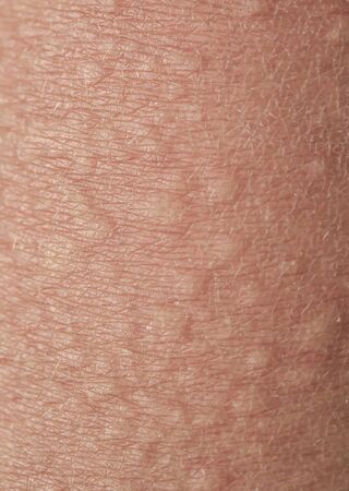 background of texture of unhealthy irritated human skin covered with fine lines ,cracks and blisters burnsの写真素材