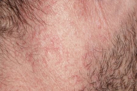  texture of irritated reddened male neck skin covered with hair and bristles