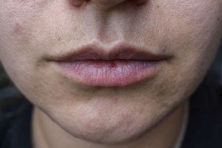 acne in the chin area. lip crack. unkempt face