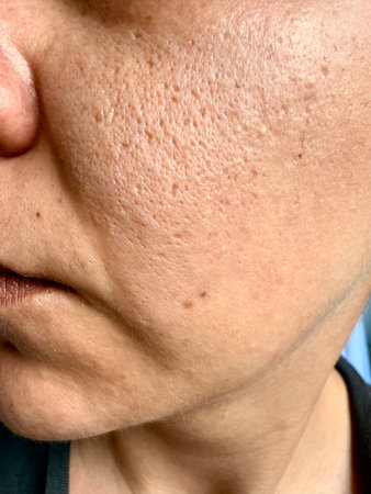 Close-up of part of the face. facial skin with enlarged pores, problem skin. Cosmetology. texture skin health.の写真素材