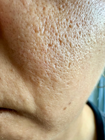 Close-up of part of the face. facial skin with enlarged pores, problem skin. Cosmetology. texture skin health.の写真素材