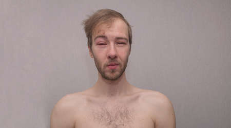 The face of a man with a puffy red eye with tears from injury, conjunctivitis
