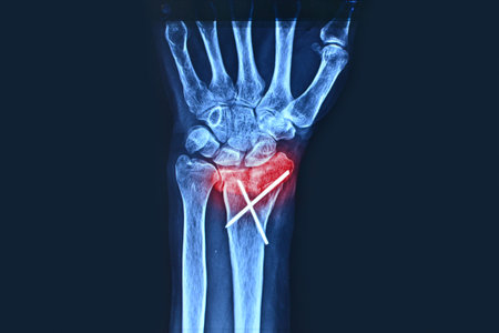 Front view x-ray of the right hand with fracture of the radius. Hand fracture.の写真素材