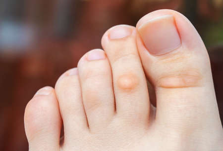 A young woman has hard corns and calluses on her toes from wearing shoes that uncomfortable and...