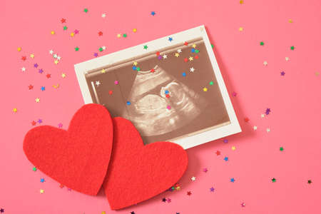 two red felt hearts and an ultrasound image on a pink background with confetti stars, gender party concept, the joy of having a babyの写真素材