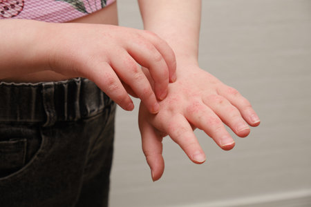 child scratching hands covered with dermatitis, skin allergy in a child, itchy redness on the skin,...