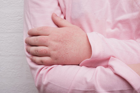 children's hands covered with atopic dermatitis, allergy on the skin of a child, redness on the...