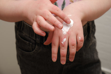 a child smears his hands with ointment for allergies to regenerate the skin, children's hands with atopic dermatitis in the form of redness and damage to the integrity of the skinの写真素材
