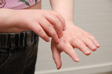 child scratching hands covered with dermatitis, skin allergy in a child, itchy redness on the skin, dry skin of the hands, atopyの写真素材