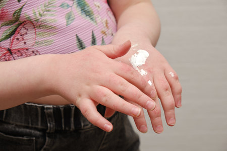 a child smears his hands with ointment for allergies to regenerate the skin, children's hands with atopic dermatitis in the form of redness and damage to the integrity of the skinの写真素材