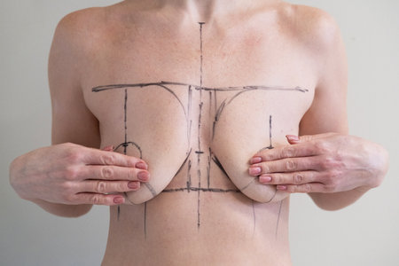 woman patient with medical surgical marks drawn on chest for plastic surgery preparation, medical...