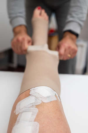leg with white patches after varicose veins treatmentの写真素材