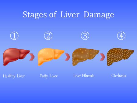 Stages of liver damage, liver disease. Healthy, fatty, liver fibrosis and cirrhosis isolated on blue background.Vector illustrationのイラスト素材