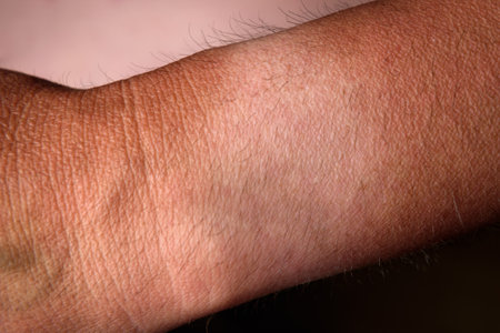 Sunburned skin on arm because of not using cream with sunscreen protection.