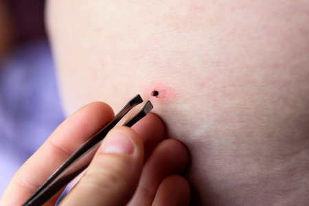 Removing an encephalitis tick with tweeters on a human bodyの写真素材