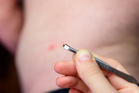Removing an encephalitis tick with tweeters on a human body