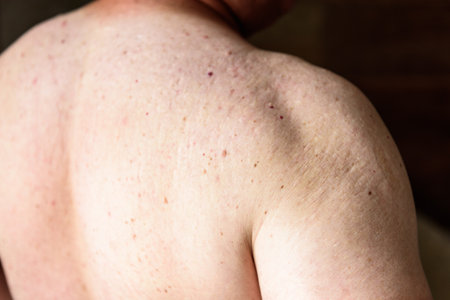 Red pimples on a man's back. Skin irritation and allergy concept.の写真素材