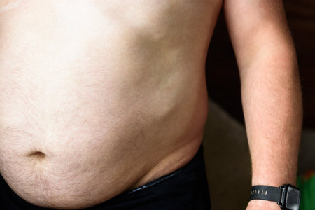 Lipomatosis or Dercum's disease (neurolipomatosis) on the man's abdomen. Foci of overgrown fatty tissueの写真素材