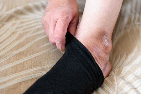 Woman's inflamed, swollen foot from a bruise on a bed at homeの写真素材