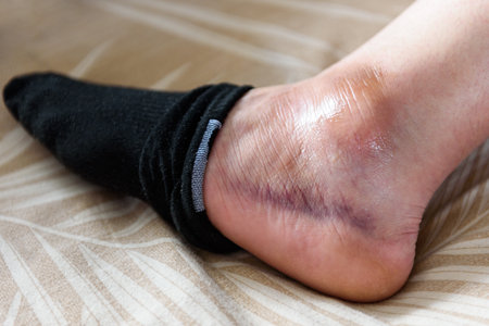 Woman's inflamed, swollen foot from a bruise on a bed at homeの写真素材