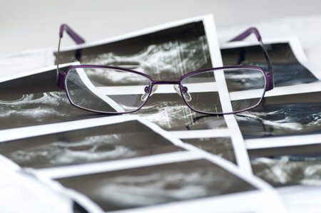 Photo shots of ultra sound study of foliculometry in the protocol of the eco program in the process...