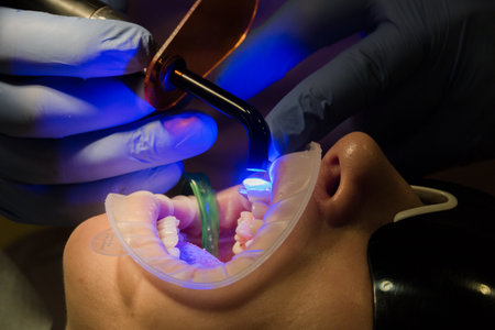 The dentist treats the patient with a device with ultraviolet radiation in dentistry. Treatment concept. Dental tool kit. Close-up of high-tech dental equipment.の写真素材
