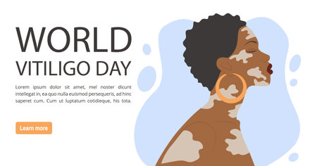 Afro-american woman illustration with vitiligo banner. World Vitiligo Day. Selfcare concept. Simple cartoon style illustration for web graphic designのイラスト素材