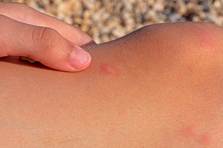 insect bite close-up on the skin near the knee. Allergic reaction. Diseases and treatment of skin...