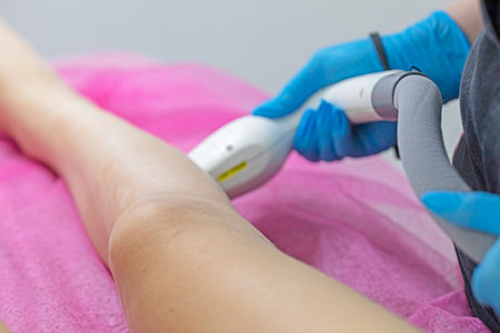 cosmetologist removes excess hair on the patient's legs with a laser attachment. laser hair removal, Self-care and careの写真素材